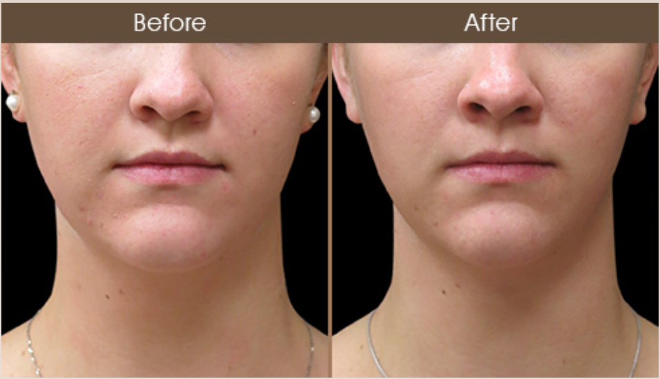 Before & After Laser Neck Lift Treatment